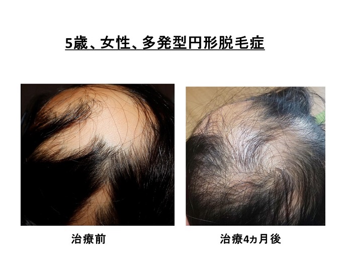 円形脱毛症　病院